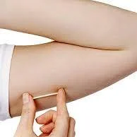 Implanon Implant Contraceptive