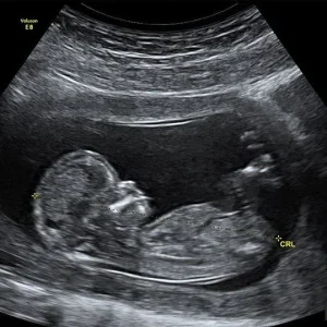 Ultrasound